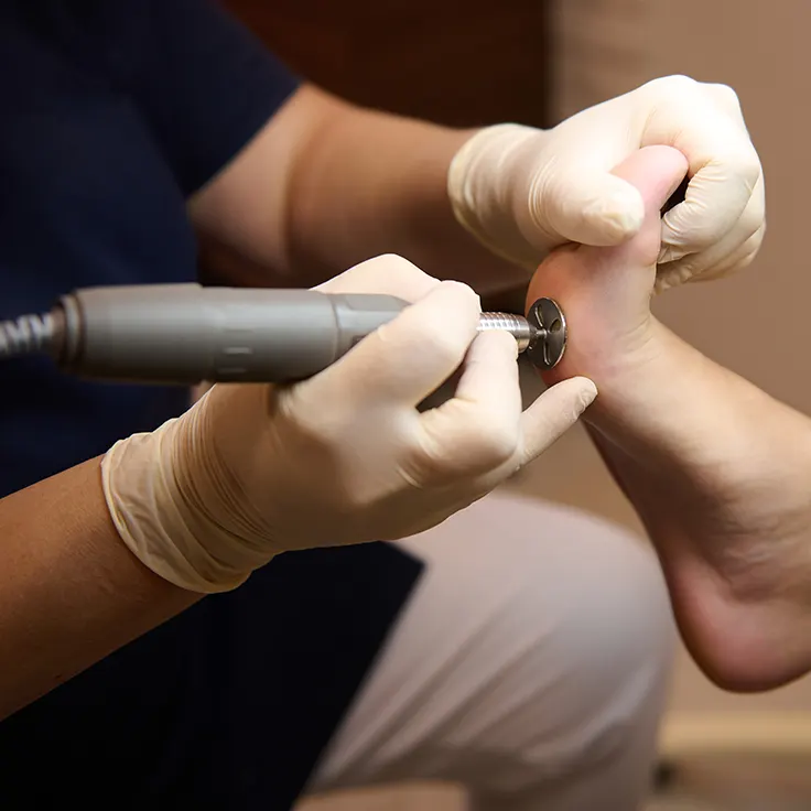 Callus Removal